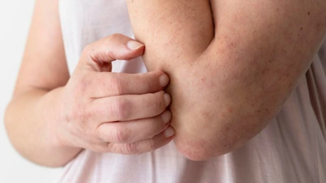 5 cách trị vết thâm muỗi đốt lâu ngày cho bé​