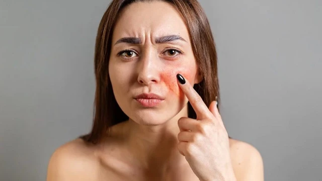 Da mỏng lộ mao mạch là do đâu? Cách khắc phục hiệu quả