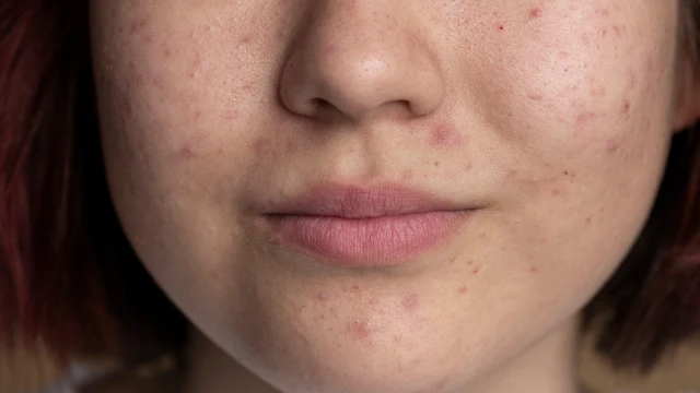 Da nhiễm corticoid: Nguyên nhân, dấu hiệu và cách phục hồi