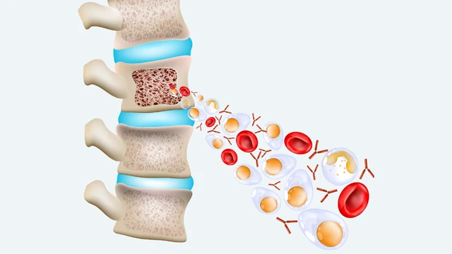 Đa u tủy xương là gì? Dấu hiệu nhận biết, chẩn đoán và điều trị