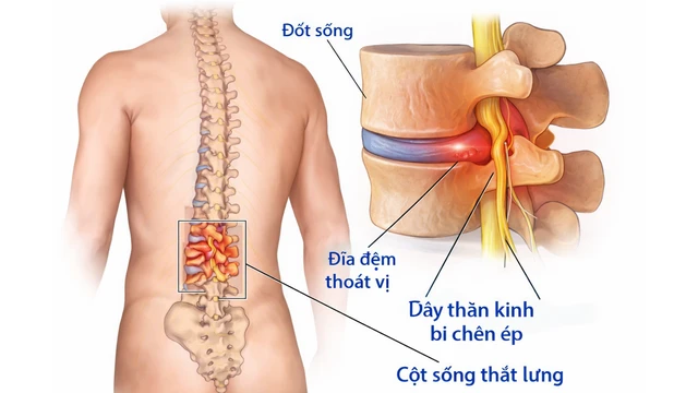 Đau dây thần kinh liên sườn gây khó thở: Nguyên nhân, dấu hiệu và hướng xử trí
