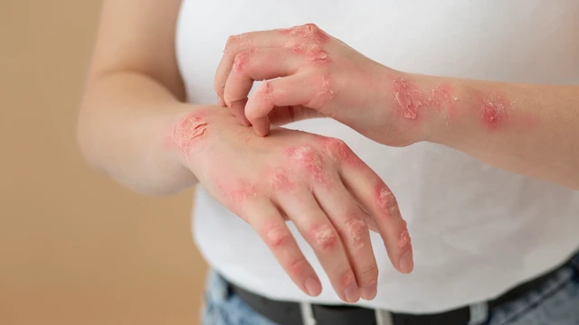 Dấu hiệu bị ghẻ: Nhận biết sớm để điều trị kịp thời