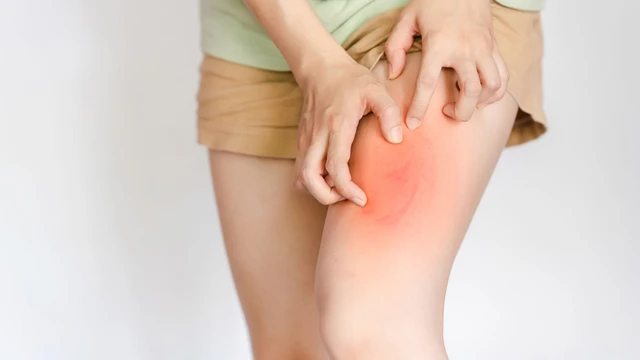 Dấu hiệu hắc lào: Nhận biết sớm & cách phòng tránh hiệu quả