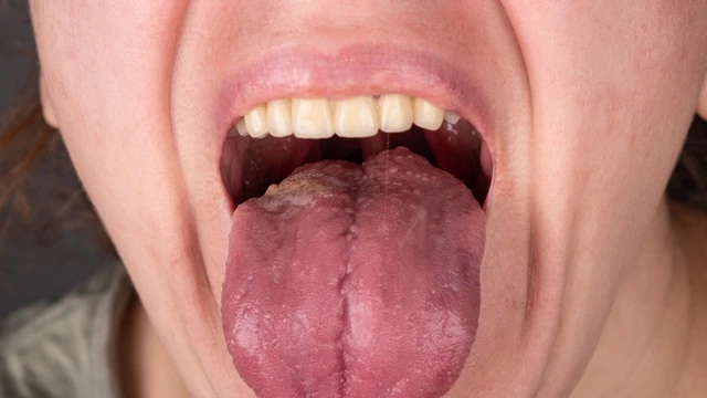 Dấu hiệu ung thư khoang miệng: 10 cảnh báo sớm dễ bị bỏ qua