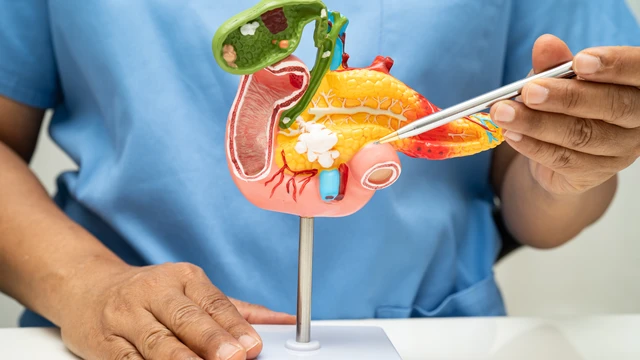 Dấu hiệu ung thư tuyến tụy: Nhận biết sớm để điều trị hiệu quả