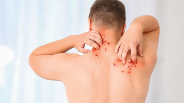 Đậu mùa khỉ là gì? Triệu chứng, nguy cơ, điều trị và phòng ngừa
