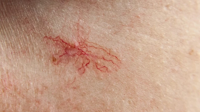 Dấu sao mạch: Nguyên nhân, dấu hiệu và cảnh báo bệnh lý tiềm ẩn