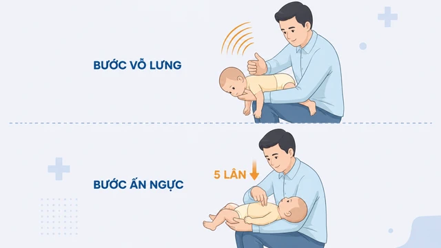 Dị vật đường thở ở trẻ em: Dấu hiệu nhận biết và cách xử trí đúng