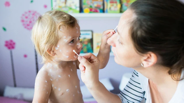 Điều trị thủy đậu ở trẻ em: Hướng dẫn chi tiết giúp mẹ chăm con đúng cách