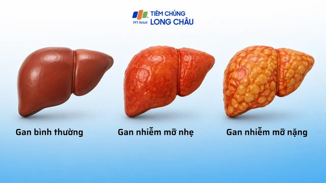 Gan nhiễm mỡ độ 4: Dấu hiệu, biến chứng và cách phòng ngừa