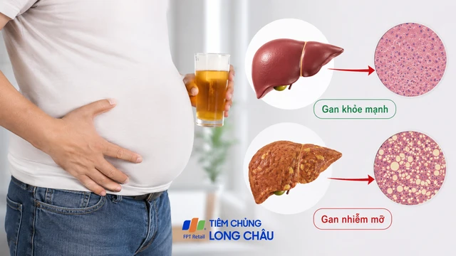 Gan nhiễm mỡ do rượu bia: Nguyên nhân, triệu chứng và cách điều trị