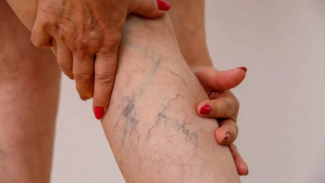 Giãn tĩnh mạch: Nguyên nhân, triệu chứng và điều trị