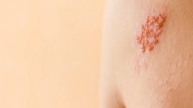 Giời leo có để lại sẹo không? Cách chăm sóc tránh để lại sẹo