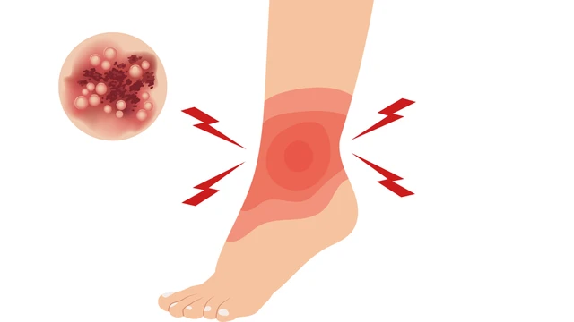 Giời leo ở chân là gì? Nguyên nhân, triệu chứng và cách điều trị hiệu quả