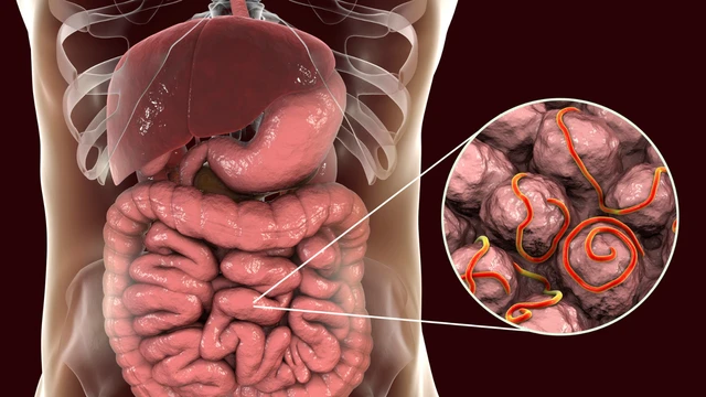 Uống thuốc tẩy giun mà vẫn còn giun kim: Nguyên nhân và cách xử lý triệt để