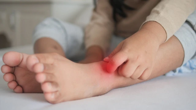 Hắc lào ở trẻ em: Nguyên nhân, triệu chứng và phương pháp điều trị