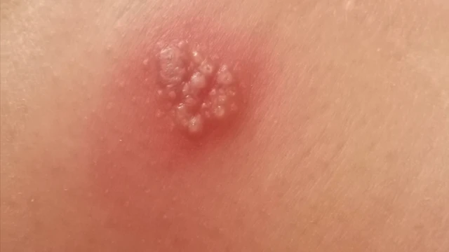 Herpes simplex virus type 1 và type 2: Nhận diện và kiểm soát hiệu quả