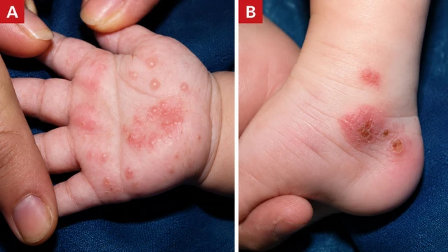 Hình ảnh bệnh ghẻ ở trẻ em: Đặc điểm nhận biết và dấu hiệu cần đi khám