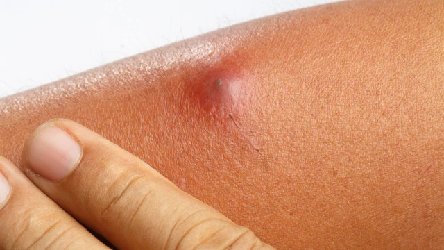 Hình ảnh bệnh ổ gà ở nách: Nhận biết sớm qua dấu hiệu điển hình