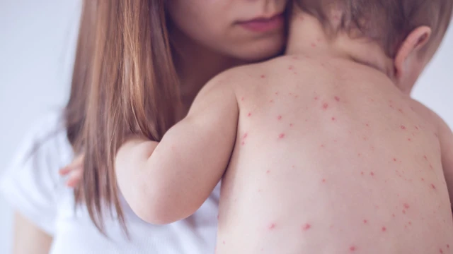 Hình ảnh bệnh sởi ở trẻ em: Hiểu biết và nhận diện qua từng giai đoạn
