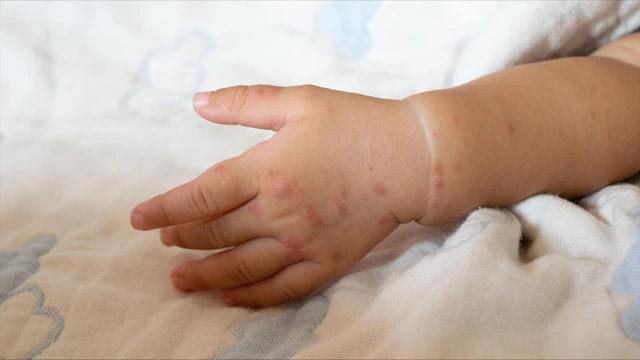 Hình ảnh bệnh tay chân miệng cấp độ 2: Dấu hiệu nhận biết và cảnh báo biến chứng