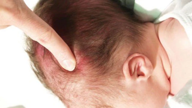 Hình ảnh bướu huyết thanh ở trẻ sơ sinh cho biết điều gì?