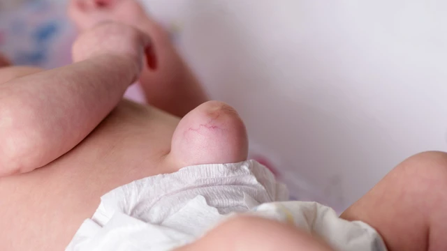 Hình ảnh rốn lồi ở trẻ sơ sinh: Nguyên nhân, cách nhận biết và xử lý