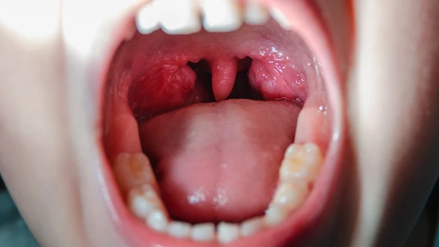 So sánh hình ảnh trước và sau khi cắt amidan