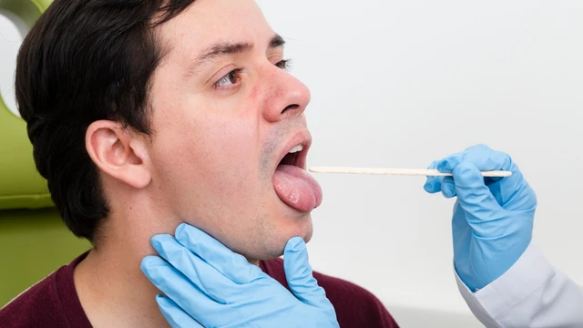 Hình ảnh viêm họng hạt trắng: Nhận biết dấu hiệu và cách xử lý hiệu quả
