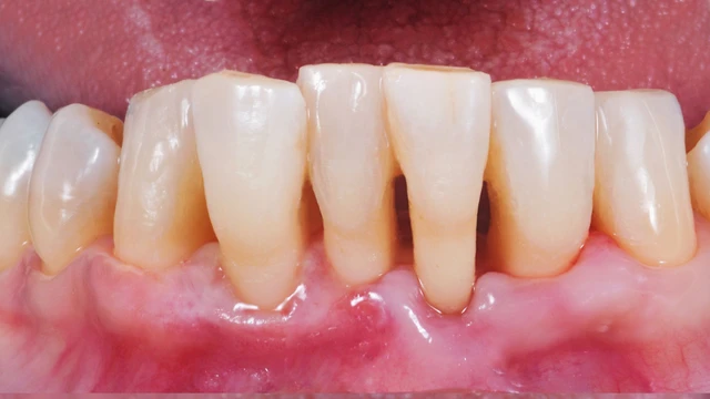 Hở chân răng là gì? Những điều cần biết về hở chân răng