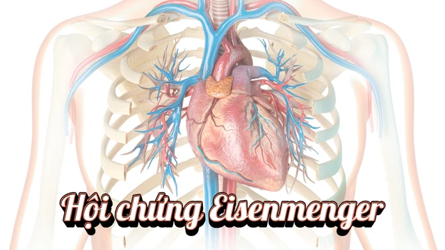 Hội chứng Eisenmenger: Nguyên nhân, triệu chứng và điều trị