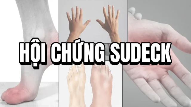 Hội chứng Sudeck: Nguyên nhân, triệu chứng và điều trị