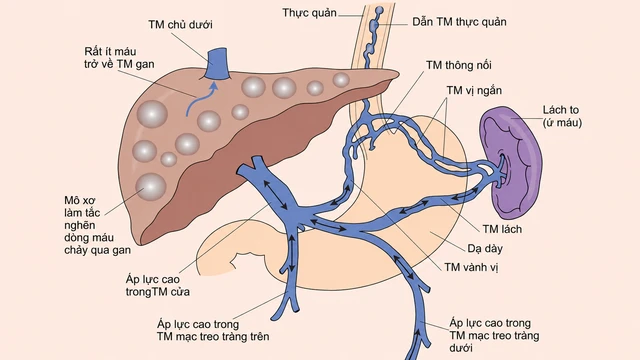 Hội chứng tăng áp lực tĩnh mạch cửa: Nguyên nhân và cách điều trị