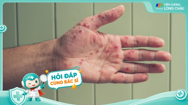 [Hỏi đáp] Bệnh tay chân miệng có tái phát không?