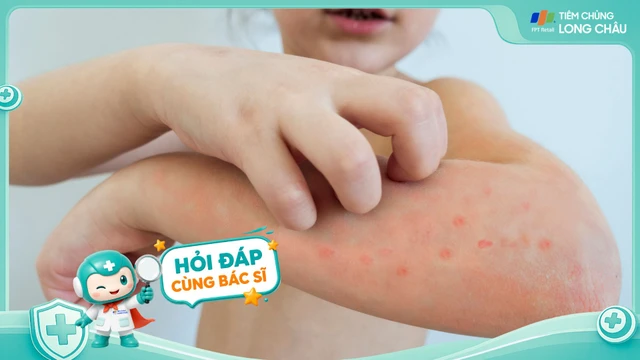 Bị thủy đậu 1 lần có miễn dịch suốt đời không?