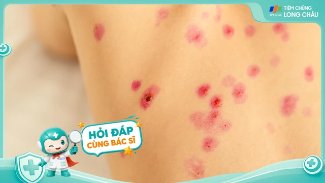 Bị thủy đậu nên ăn gì và kiêng gì để nhanh khỏi?
