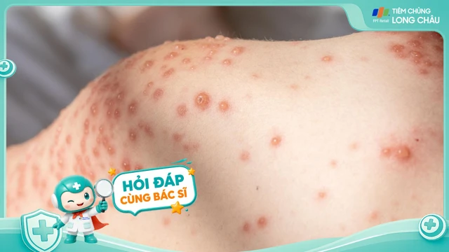 Biến chứng của bệnh thủy đậu là gì?