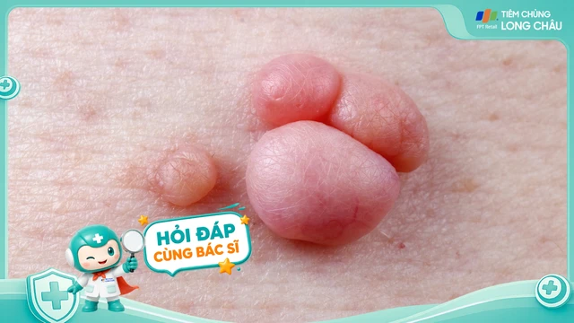 Sùi mào gà nguy hiểm như thế nào?