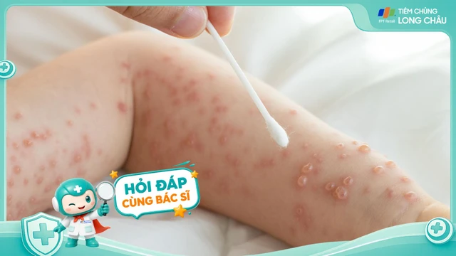 Thủy đậu có thể để lại sẹo không? Cách ngừa sẹo?