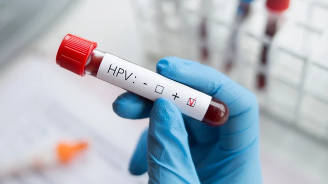 HPV dương tính có sao không? Kết quả xét nghiệm HPV có thể thay đổi theo thời gian không?