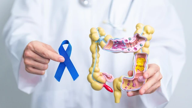 Khi nào cần nội soi cắt polyp đại tràng?