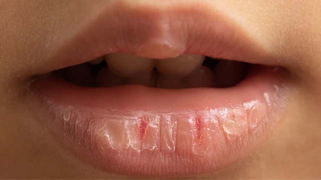 Khô miệng là gì? Nguyên nhân và cách khắc phục hiệu quả