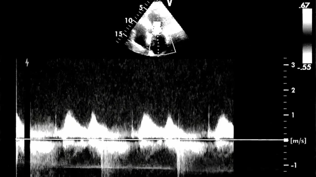 Khối echo là gì? Phân loại khối echo