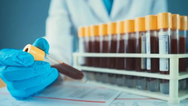 Lactate là gì? Khi nào cần xét nghiệm lactate máu?