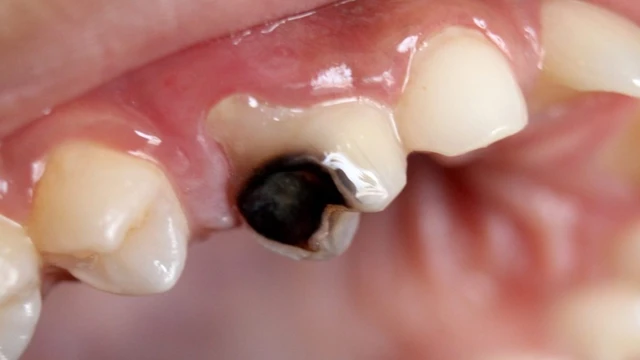 Làm gì khi trẻ bị sâu răng sữa và cách xử lý đúng đắn cha mẹ cần biết