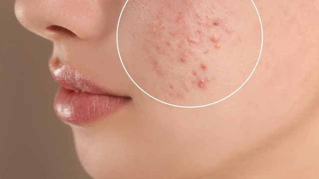 Phải làm sao để không bị mụn khi đến tháng?
