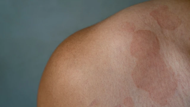 Lang ben đỏ: Nguyên nhân, triệu chứng và cách phòng ngừa