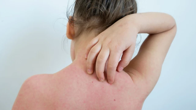 Lang ben ở lưng: Nguyên nhân, triệu chứng và cách phòng ngừa