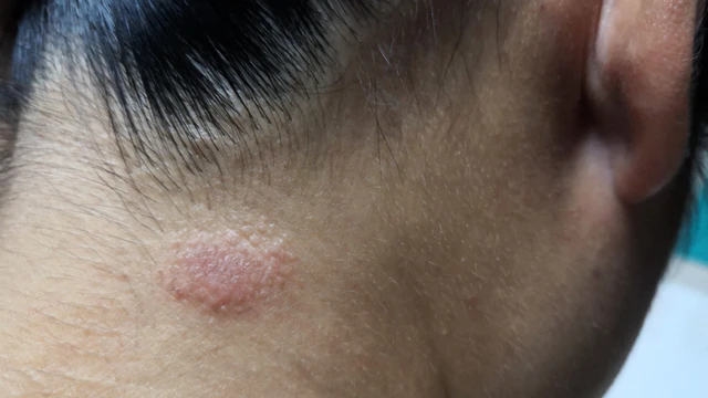 Lang ben ở mặt: Dấu hiệu và cách điều trị