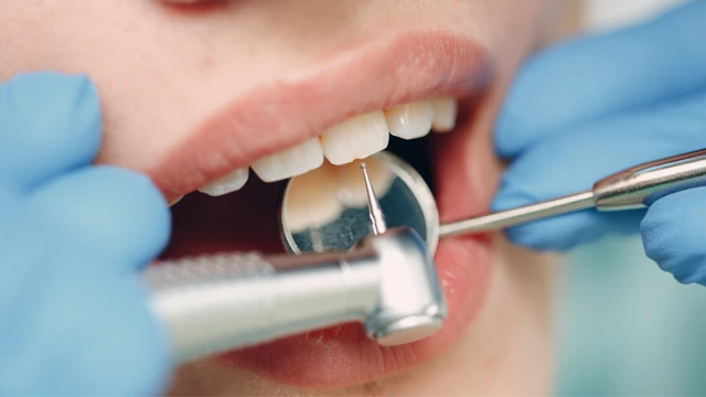 Lấy cao răng có đau không? Một số lưu ý khi lấy cao răng